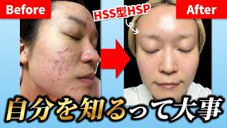 【HSS型HSP】肌荒れに悩み続けて色々試した結果、1番必要だと感じたこと