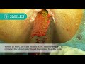 You Will Not Believe What Our Doctors Removed Out Of A Patient At SIICP