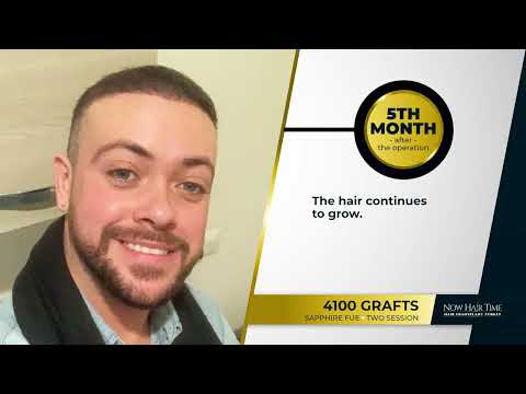 Norwood 5 - Hair Transplant Before & After - 12 Months Results