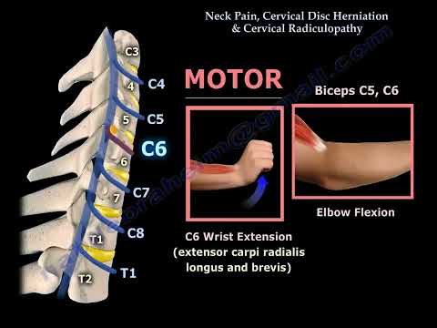 Hernie Discale Cervicale : Causes, Symptômes et Traitement des Cervicalgies et de la Radiculopathie