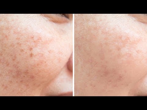 Permanently Get Rid Of Freckles in Naturally ||...