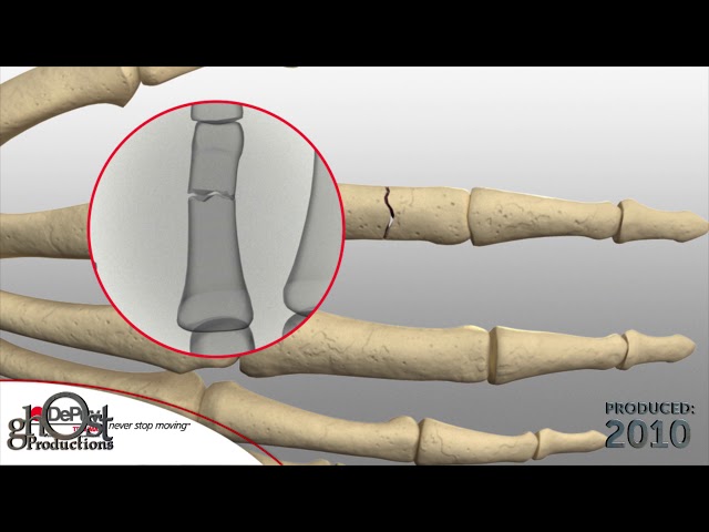 Wymowa wideo od dePuy na Angielski