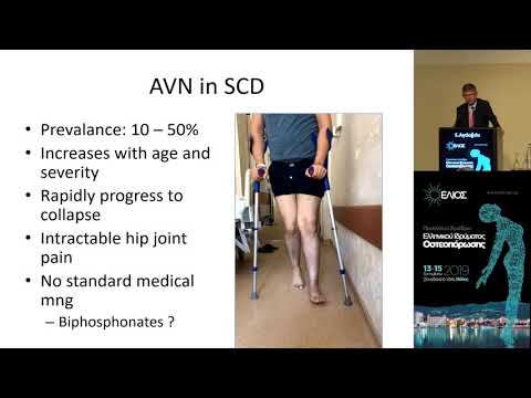  Aydoğdu S. - Musculoskeletal involvement in hematological disorders