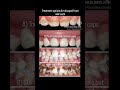 Treatment options for Decayed front milk teeth in kids. #pediatricdentist #kidsdentist #milkteeth