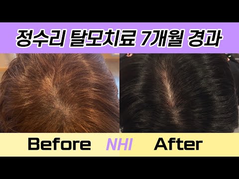 정수리탈모치료 정수리모발개선 210일 경과 I 뉴헤어 I 엑소좀 탈모치료 I Before&After