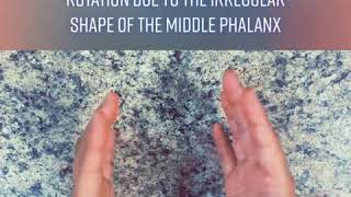 Therapist challenge Part 2 (Clinodactyly)