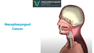 Nasopharyngeal Cancer - What Is It? What are the Symptoms and Treatment? Head and Neck Cancer