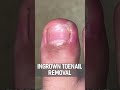 INGROWN TOENAIL REMOVAL FULL VIDEO Shorts Myfeetarekillingme
