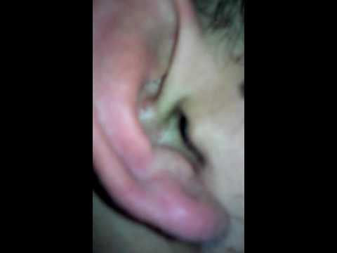 Hernija analnog seksa