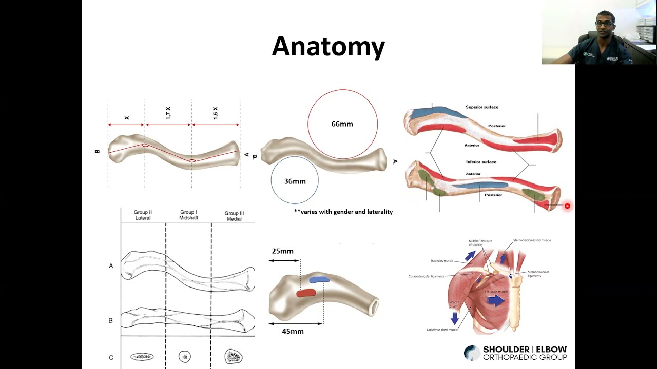 How to Avoid Complications in Clavicle Fracture Fixation Dr Ruben Manohara Shoulder Elbow