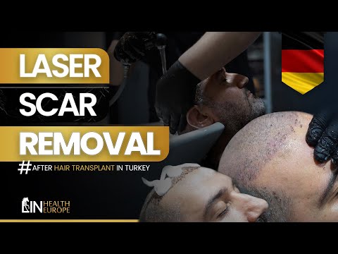 Hair Transplant Scar REMOVAL with Laser! 😱 | Real Results at Lin Europe Clinic