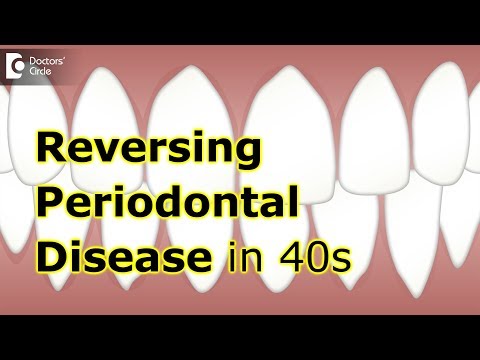 Can moderate periodontal disease be reversed in 40's? - Dr. Ranjani Rao
