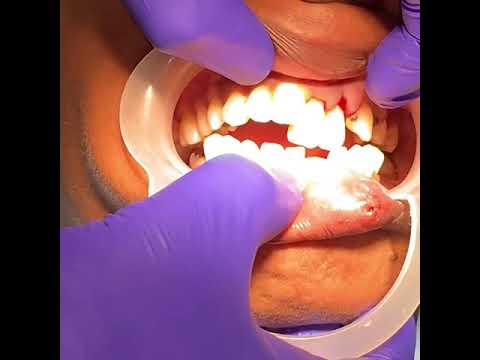 Dentoalveolar Fracture Reduction