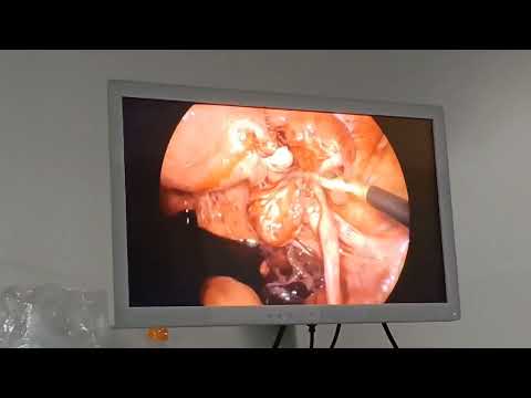 Laparoscopic Salpingectomy