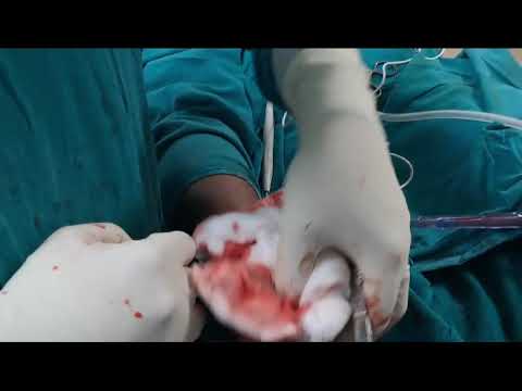 Chronic Osteomyelitis of Calcaneum : Dr Sunny Dole