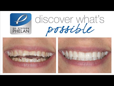 Full Mouth Rehabilitation For Advanced Tooth Wear And Erosion Case Study