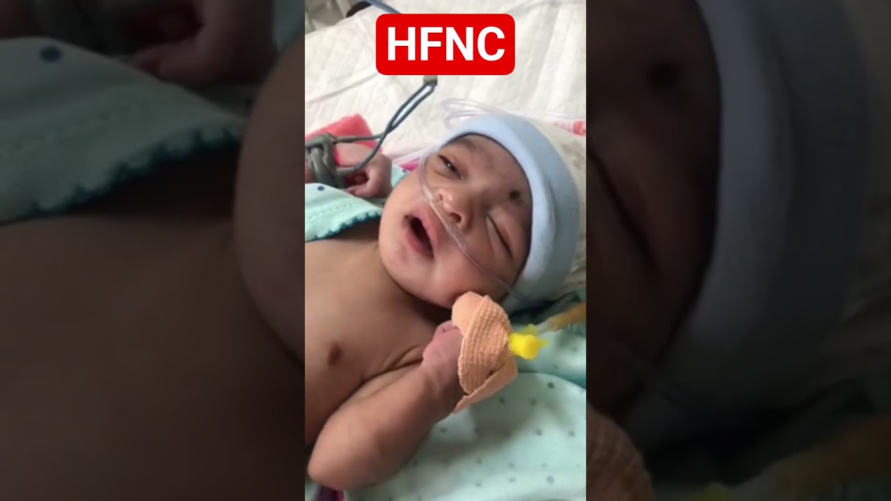 HFNC #nicu #picu #baby #neonatologist #newborn #icu #hospital #yt #nicu #fypp #fyppp #mbbs #bams
