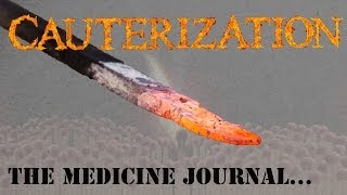 Does Cauterizing A Wound Really Work?