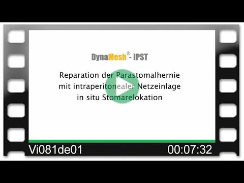 DynaMesh®-IPST - OP-Video: Reparation der Parastomalhernie in intraperitonealer Netzeinlage