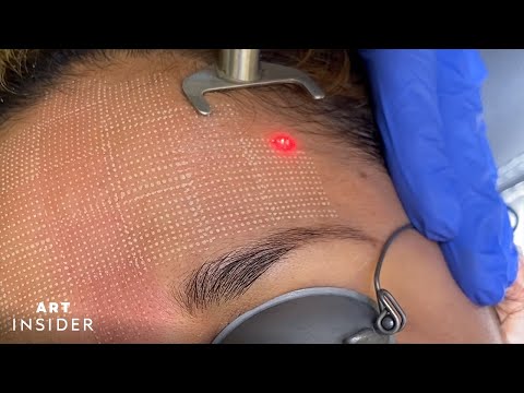 Minimize Acne Scarring With Laser Resurfacing