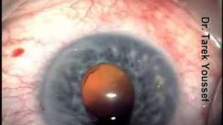 Limited Expulsive Hge vs Aquious misdirection syndrome