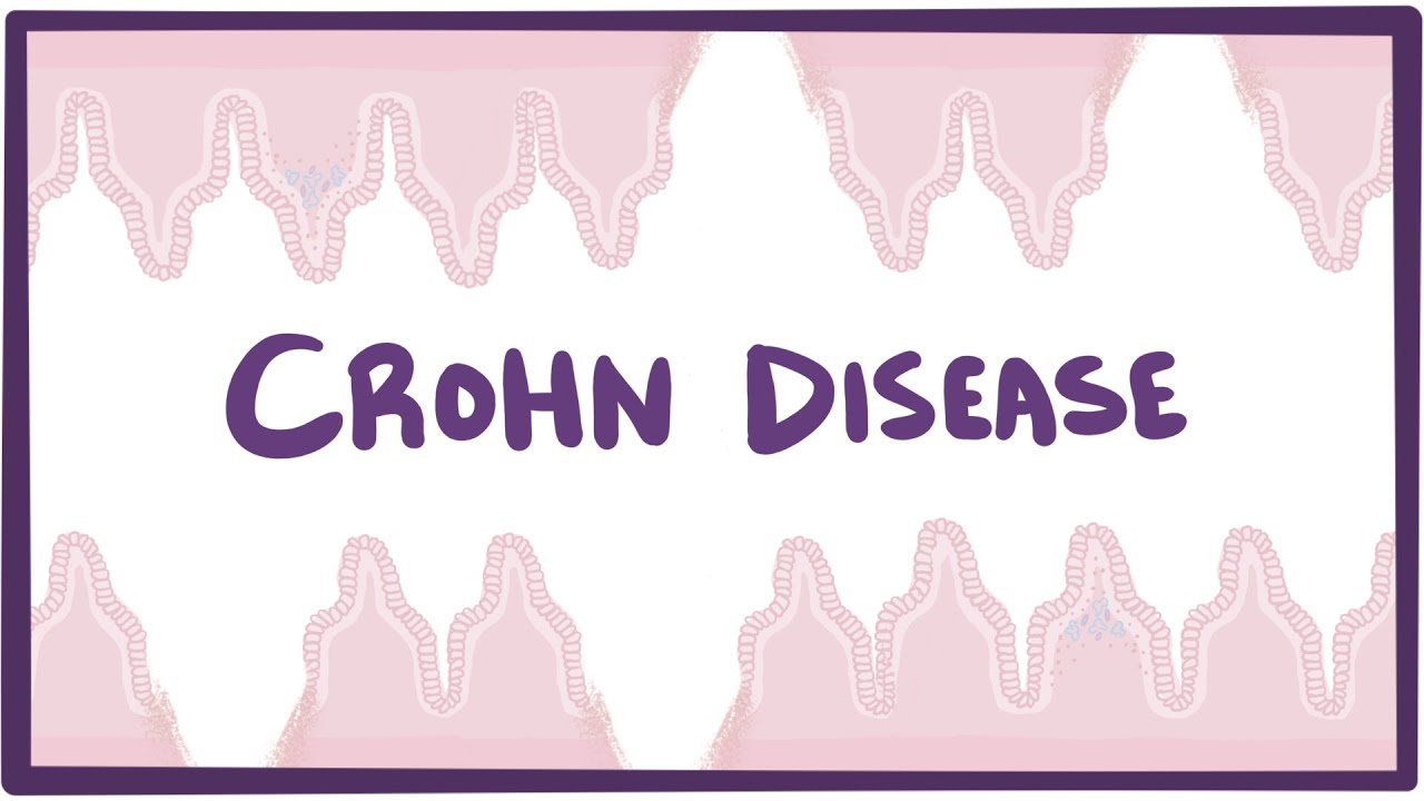 Crohn's disease (Crohn disease) - causes, symptoms & pathology