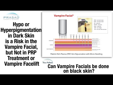 Pigmentary bianco nota su un corpo su pelle Crema da risposte di lentiggini
