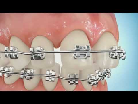 For Beautiful Smile | Space Closure by Power Chain