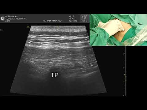 The Erector Spinae Plane (ESP) Block Demo