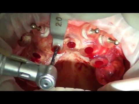 Cirurgia Guiada de Implantes Dentários com Carga Imediata
