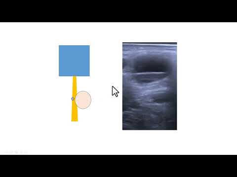 Avaliação do adequado posicionamento da agulha na biópsia de fragmento guiada pela ultrassonografia