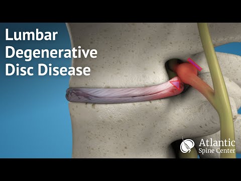 Lumbar Degenerative Disc Disease Overview