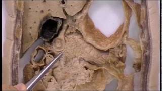 preview picture of video 'sectional anatomy of the abdomen and pelvis coronal section 1'