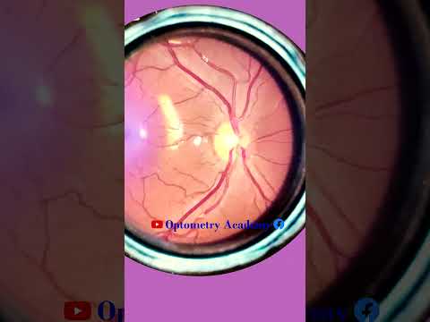 Normal fundus | Normal Retina | Smartphone Fundus Videography | Fundus Photography | Short Video 89