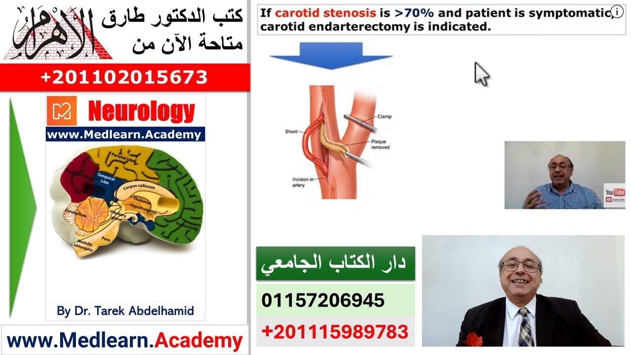 Transient Ischemic Attacks (Neurology) (4) #CME #Internal_Medicine #USMLE #medlearn   محاضرات باطنة#