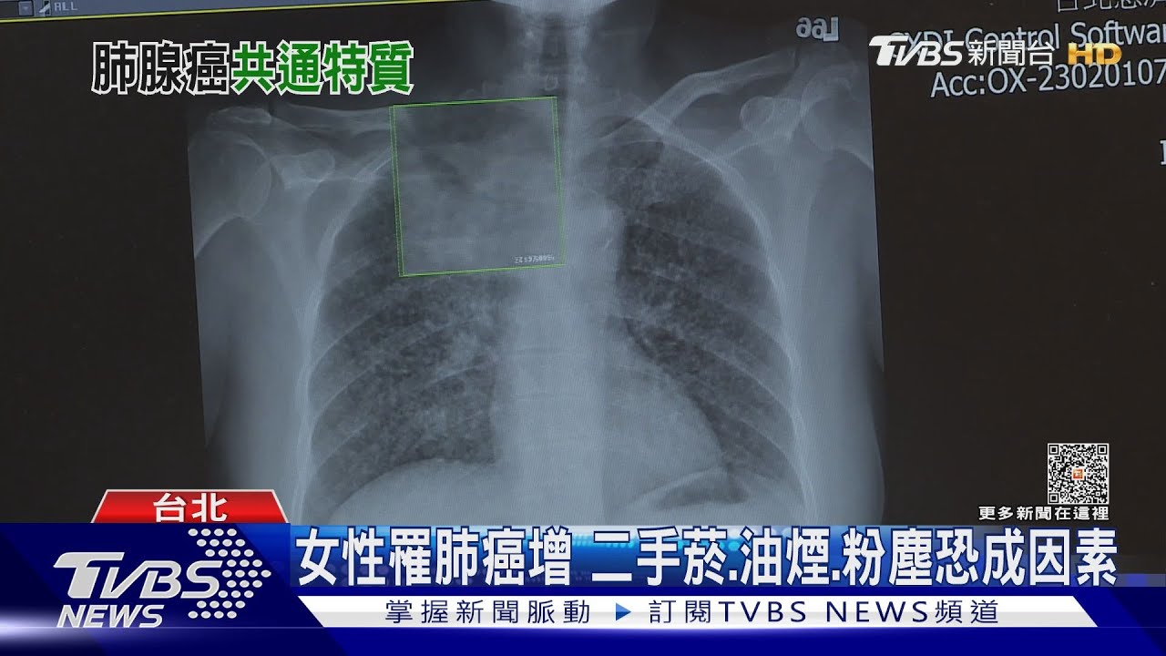 注意!不抽菸也會得肺腺癌 近年女性比例增