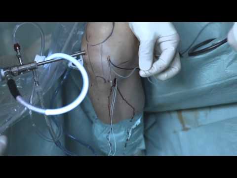 Eine Hüftoperation der besten Kliniken in Moskau Schmerzen in der rechten Seite von der Niere zurück