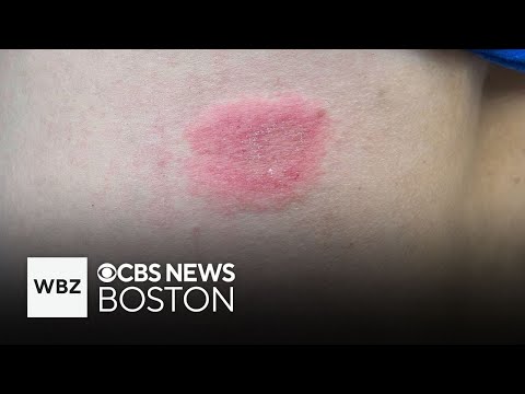 What is ringworm and how is it treated?