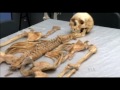 A Medieval Skeleton Holds Clues to Leprosy's Spread