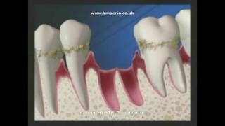 Gum Disease Treatment - Scaling & Root Planing.