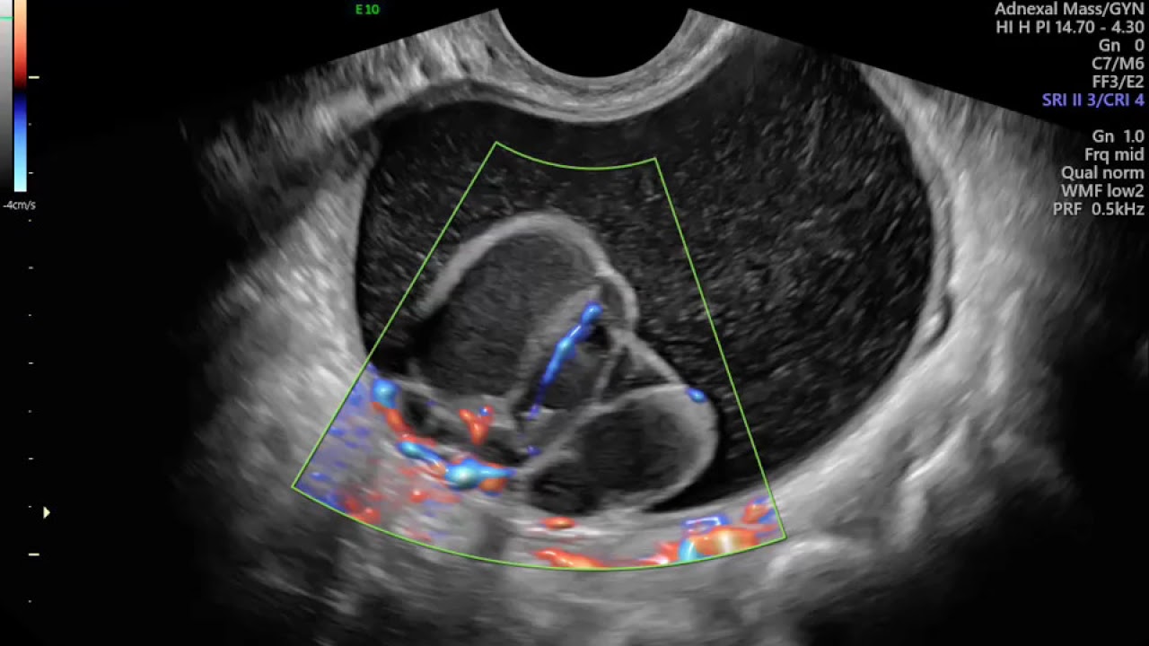 ULTRASSON ENDOVAGINAL MOSTRANDO TUMOR CISTICO OVARIANO