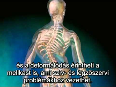 visszér és a gerincferdülés