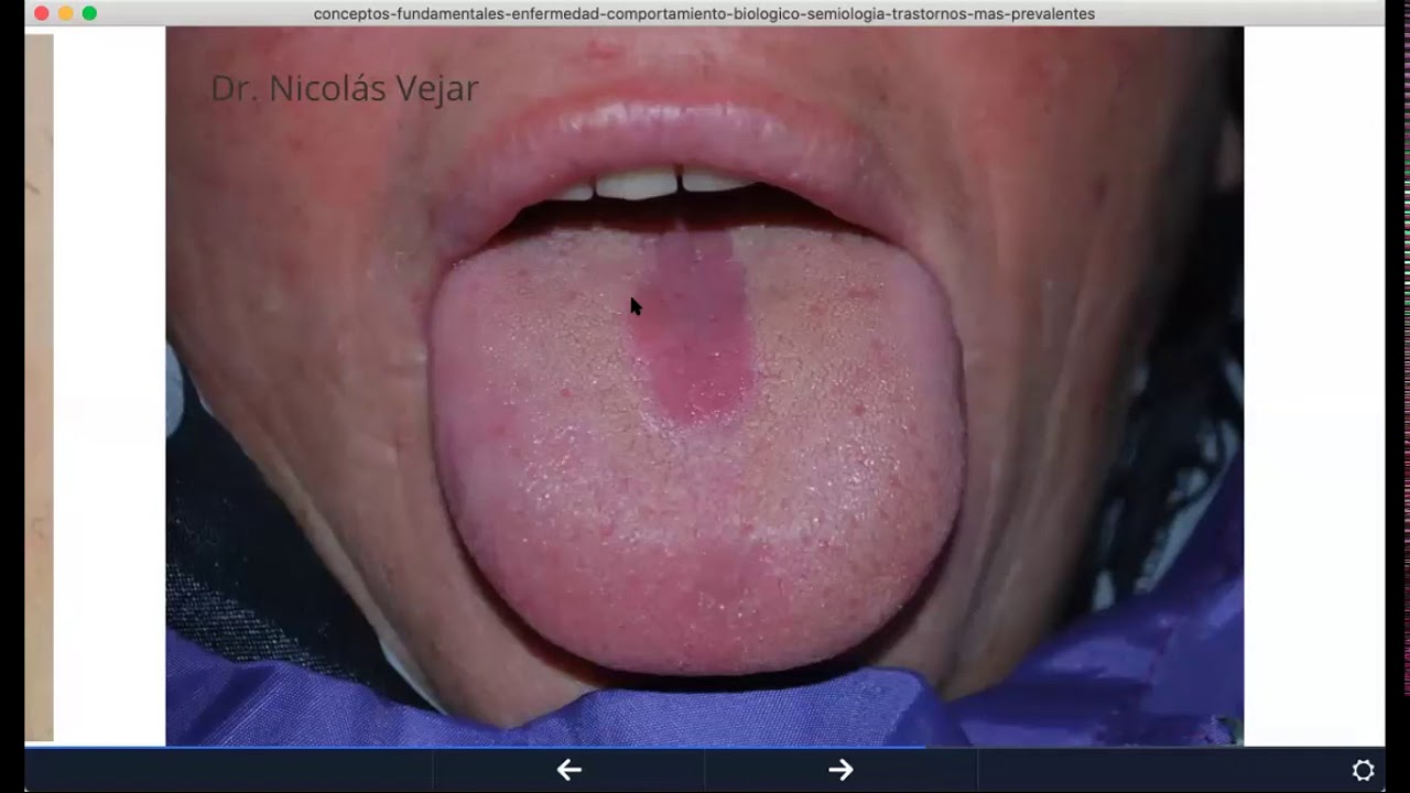 Lesiones en lengua: glositis romboidal media, glositis migratoria, liquen plano, neurilemoma.