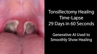 Healing Time Lapse After Tonsillectomy: 0-29 Days in 60 Seconds