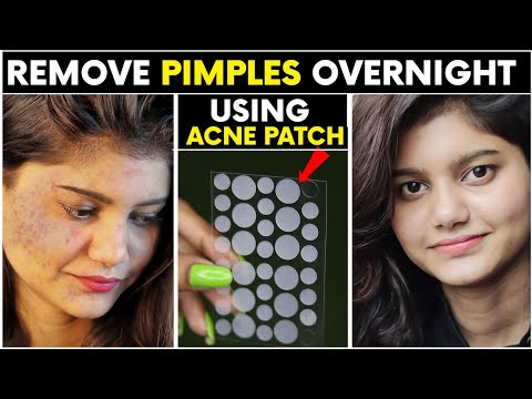 Modulyss acne pimple patch 72 pcs - invisible facial sticker...