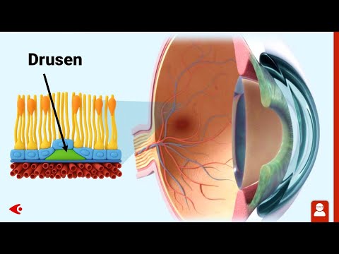 Dry macular degeneration: Animation