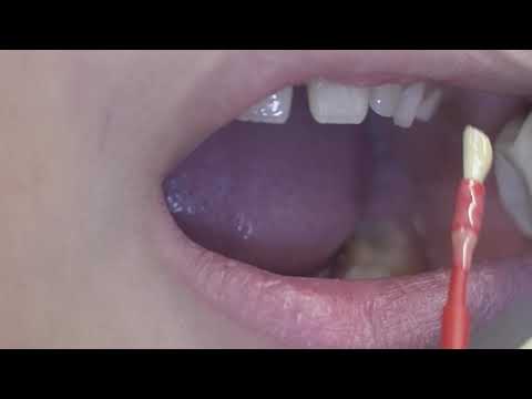 Fluoride Varnish Application