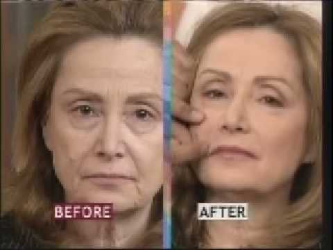 Minimally Invasive Facial Rejuvenation Procedures