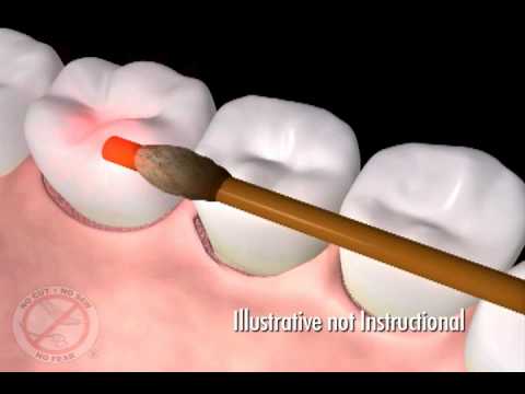 LANAP Animation, Treatment provided by Dr. Paul Kazmer