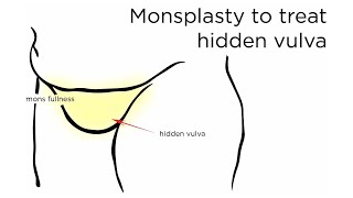Monsplasty: FUPA Correction | how to treat excessive mons | Newport Beach Plastic Surgeon explains